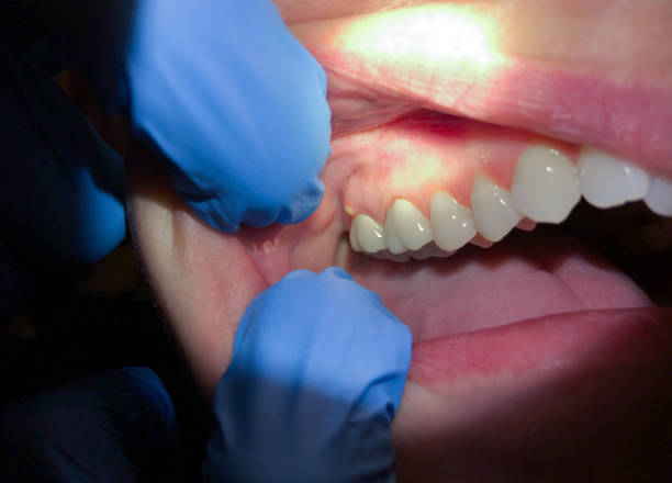 Best Emergency Dentist for Lost Fillings or Crowns in Jermyn, PA